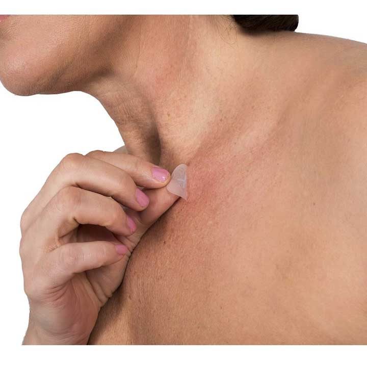 Skin Tag Patch on a Female neck